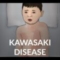A Closer Look at Kawasaki Disease: Symptoms and Treatment Options