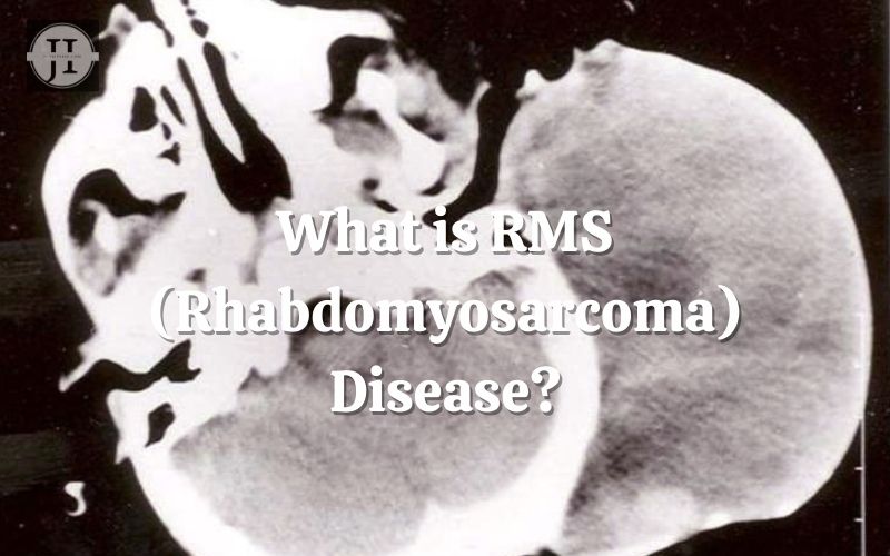 What is RMS Disease?